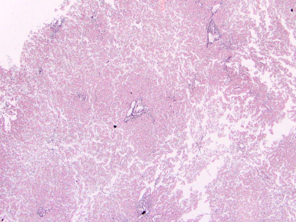Reticulin stain: Highlights reiculin fibers (which are argyrophilic) in parenchymal