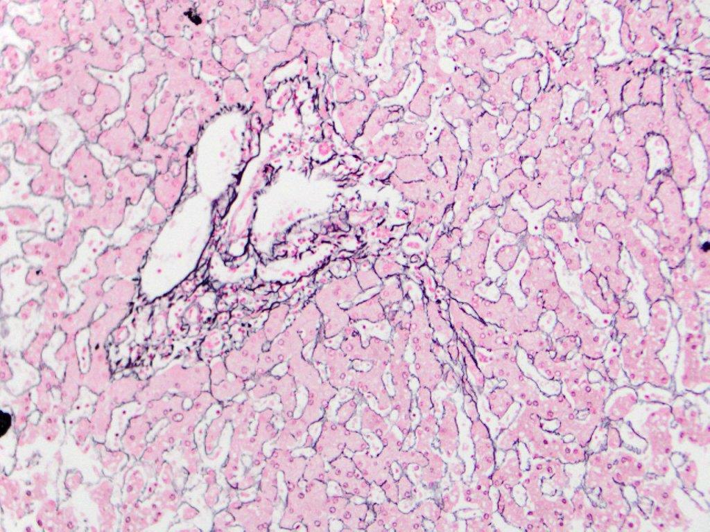 Reticulin stain: Highlights reiculin fibers (which are argyrophilic) in parenchymal