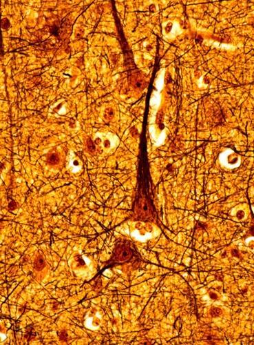 Bielschowsky stain: Demonstrates neurofibrillary tangles, nerve