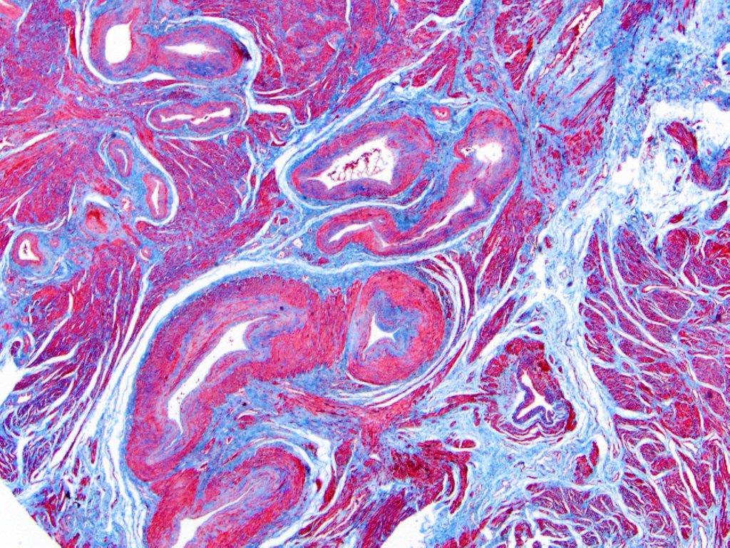 Masson s trichrome stain: Differentiates collagen fibers from smooth muscle; routine stain