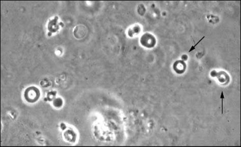 Urine Microscopy: Acanthocytes