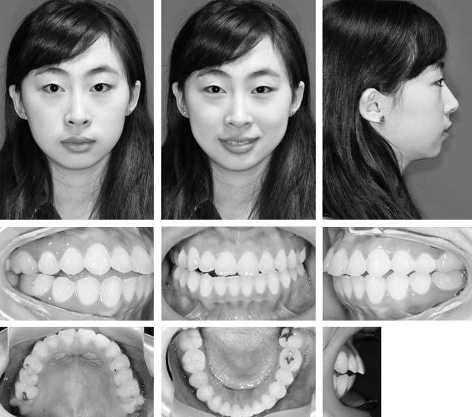 336 SONG, HE, CHEN Figure 1. Pretreatment facial and intraoral photographs. received previous fixed orthodontic treatment at age 11, which lasted for 2 years.