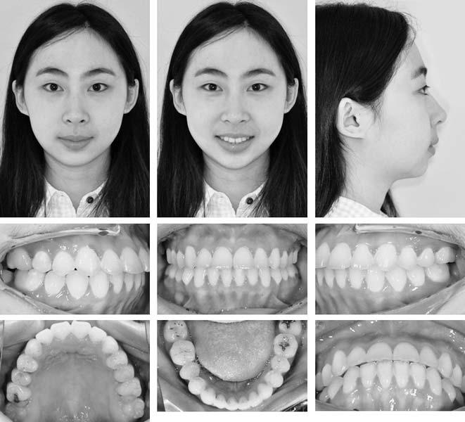 TMD WITH SKELETAL OPEN BITE TREATMENT 343 Figure 10. Posttreatment facial and intraoral photographs. anterior/lateral guidance was also achieved after orthodontic treatment, as shown in Figure 13.