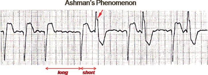 CHAPTER 19 Cardiac Arrhythmias 353 FIGURE 19-12 Ashman s phenomenon describes an aberration of a complex that represents a normal physiologic response.