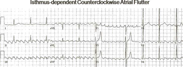 A wide QRS complex (arrow) is usually seen when a long cycle is followed by a short cycle, as the refractory periods of the conduction system have not yet recovered.