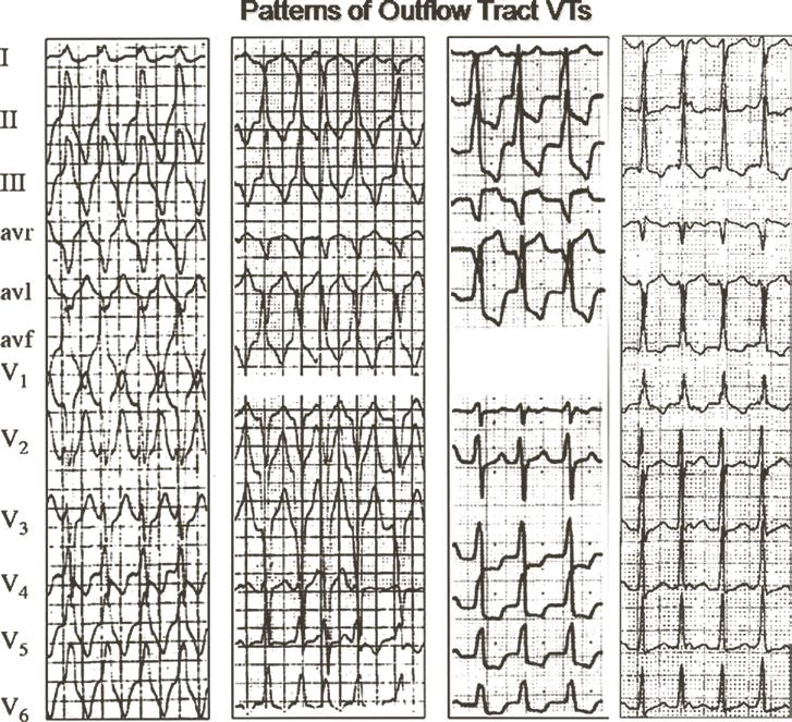 CHAPTER 19 Cardiac Arrhythmias 361 FIGURE 19-22 Electrocardiograpahic patterns of outflow tract VTs are characterized by (1) tall, rapid upstroke QRSs in the inferior leads, (2) negative avr and avl