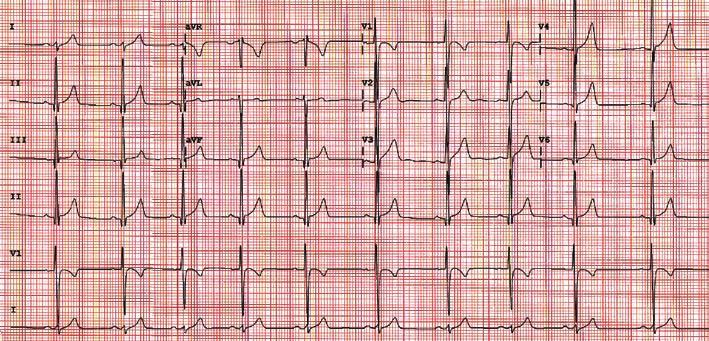 CHAPTER 19 Cardiac Arrhythmias 363 CASE STUDY: PART 1 A 24-year-old man was referred for evaluation of symptomatic tachycardia.