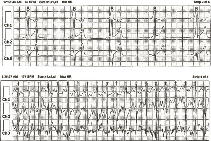 He had atypical chest pain, rapid palpitations, visual disturbances, and mild lightheadedness without dyspnea.
