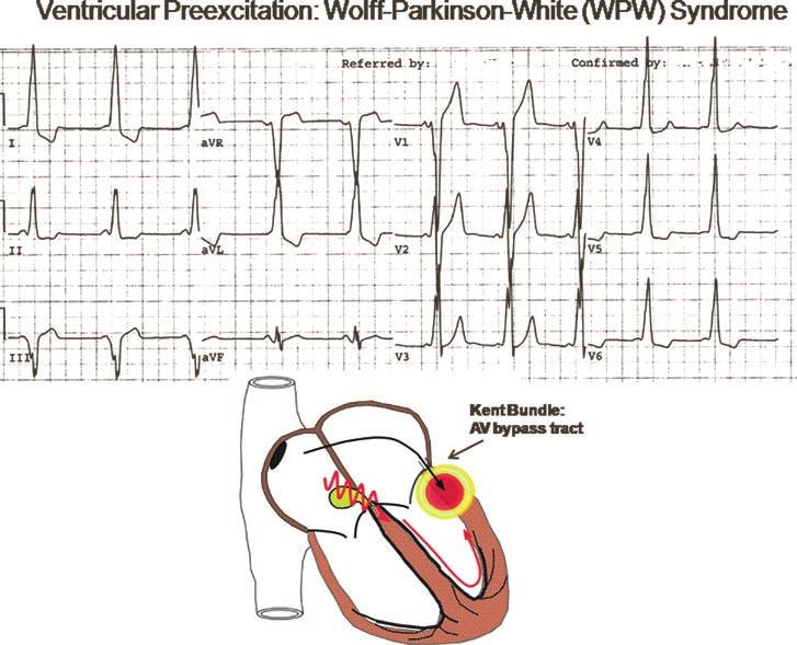 364 J.M. Hsing and H.H Hsia FIGURE 19-24 Wolff-Parkinson-White (WPW) syndrome. The ventricular activation occurs over both the normal AV node-hps and an AV bypass tract (Kent bundle).