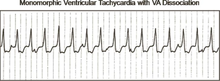 366 J.M. Hsing and H.H Hsia TABLE 19-7 STEPWISE APPROACH TO DIFFERENTIATE WCTs 1. What is the relationship of atrial and ventricular events? 2. What is the width of the QRS complex? 3.