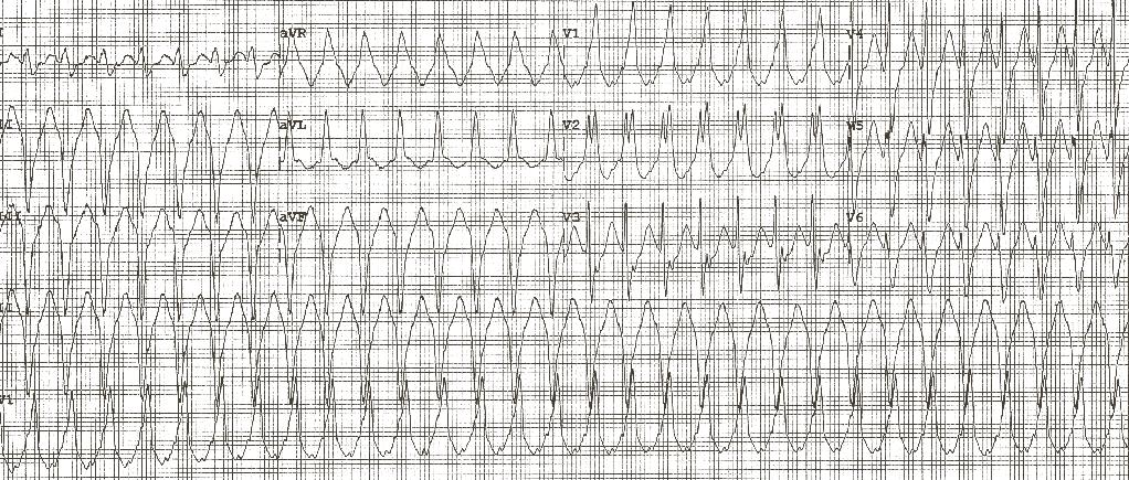 CHAPTER 19 Cardiac Arrhythmias 367 CASE STUDY: PART 2 A 76-year-old man presented with syncope and an acute cerebrovascular accident.