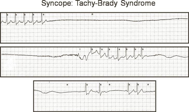 348 J.M. Hsing and H.H Hsia FIGURE 19-7 Tachy-brady-syndrome with SND.