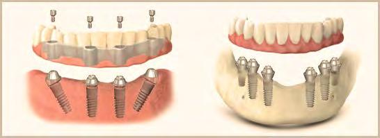 BIO Multi-Units are available for all our Bone Level Implants