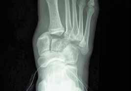 Anatomical reduction and stable internal fixation have been widely recognized as being critical in the successful surgical treatment of fracture-dislocations of the Lisfranc joint.