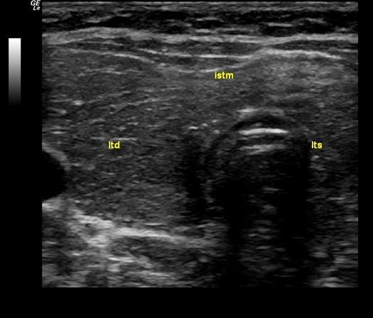 Fig. 6. Thyroglobulin values in 5 patients Fig. 7. Thyroid ultrasound revealing enlarged thyroid with inhomogenoues structure, echogenic septum within the gland, normal vascularisation. References 1.