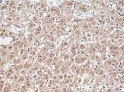 thoroughly. TK1 expression was evaluated in 376 lung cancer tissue cores representing 172 individuals and 63 normal lung cores from 29 individuals.