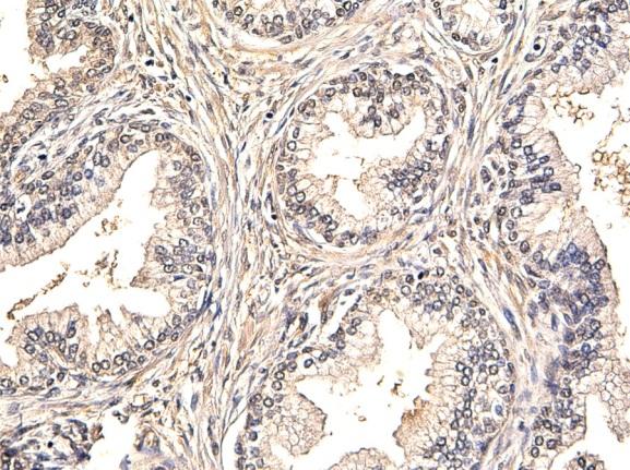 A B C D Figure 3. TK1 staining in prostate cancer No TK1 staining was found in A) normal prostate and B) prostate hyperplasia.