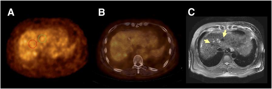 RGB FIGURE 3. (A) PET, (B) fusion, and (C) MRI scans of patient with negative T SUVmax /L SUVmax of 0.99. SUV max of tumor, SUV max of liver, and SUV mean of liver were 2.50, 2.53, and 2.