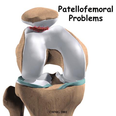 Alignment or overuse problems of the patella can lead to wear and tear of the cartilage behind the patella. This produces pain, weakness, and swelling of the knee joint.