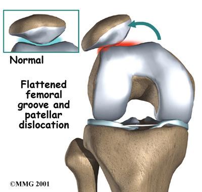 this angle within the femoral groove. When the quadriceps muscle contracts, the angle in the knee straightens, pushing the patella to the outside of the knee.