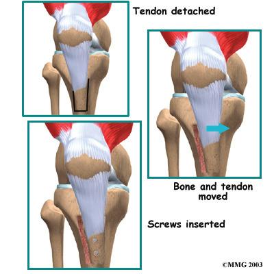 by the surgery, but they no longer pull the patella to the outside as strongly as before the surgery.