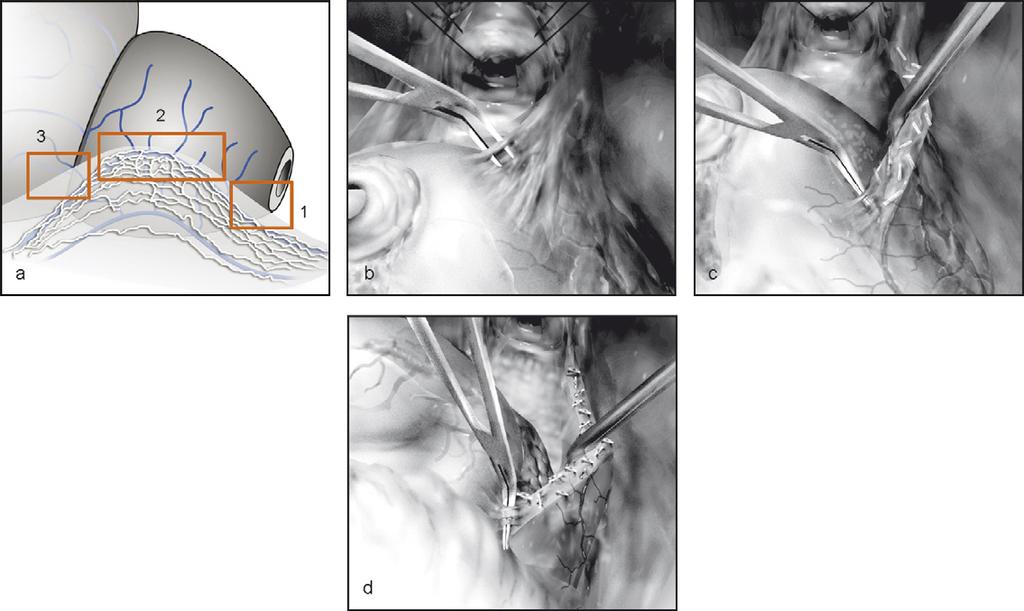 fascia (arrow 1, intrafascial dissection; arrow 2, interfascial dissection; arrow 3, extrafascial resection). (b) Antegrade dissection; red arrows, dissection errors. (c) Retrograde dissection. edge.