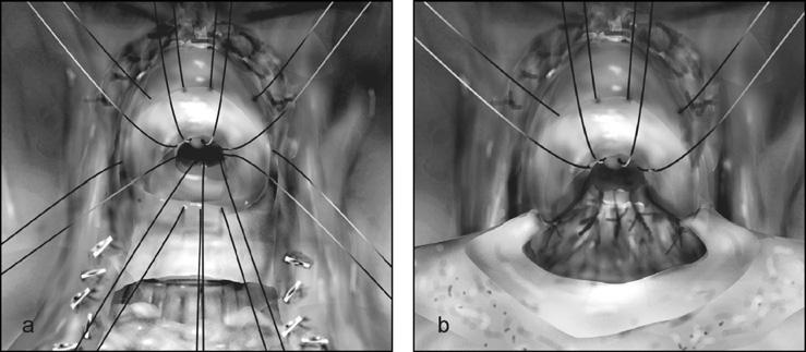 european urology 52 (2007) 71 80 77 inside the seminal vesicles/bladder neck plane, leaving a surgical loop as a landmark [19] (Fig. 7b).