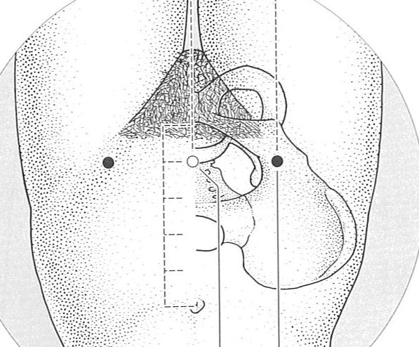 Zigong (Palace of the Child (Uterus)), Tituo (Lift and Support) zigong Tituo On the lower abdomen, 3 cun lateral to the midline, level with RN3.