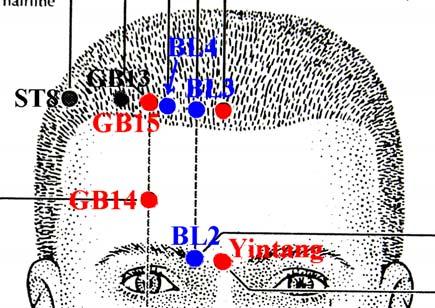 Yintang (Hall of Impression) At the glabella, at the midpoint between the medial extremities of the eyebrows.