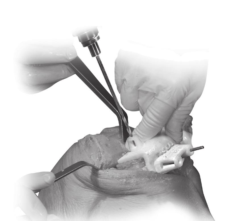 4 Remove Tibial Pin Guide Remove the Pin Guide by lifting the medial hook off the posterior ridge and sliding off the anterior lateral pin (Fig. 5).