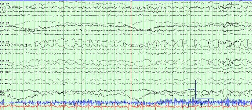 Seizures Seizures can begin: In one part of the brain-focal onset or focal seizures (partial seizures) EEG