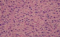 CASE REPORT Pleomorphic Sarcoma of Breast: A Report of Two Cases and Review of Literature Anju Bansal, Manveen Kaur, and Varsha Dalal Department of Pathology, National Institute of Pathology (ICMR),