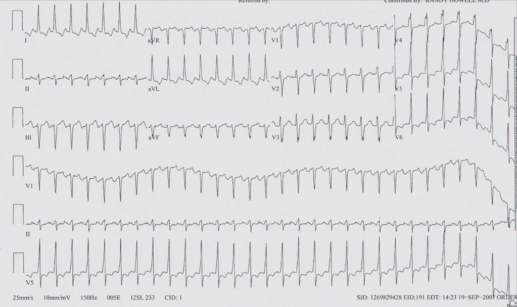 Narrow Complex Tachycardia Case 1 Rate 180 bpm Narrow QRS, no clear p waves Short RP