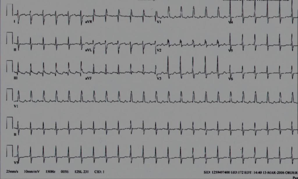 SVT Case #2 HR 150s, almost RBB and RAD.