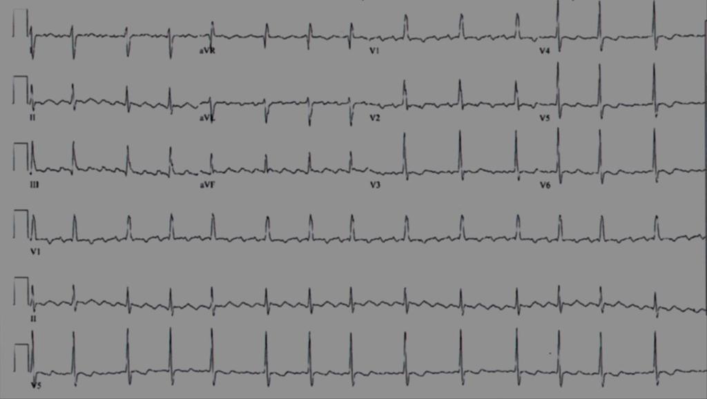 SVT Case #2: After Adenosine Now can see the flutter waves Heparin drip started, BB for rate control TEE to r/o