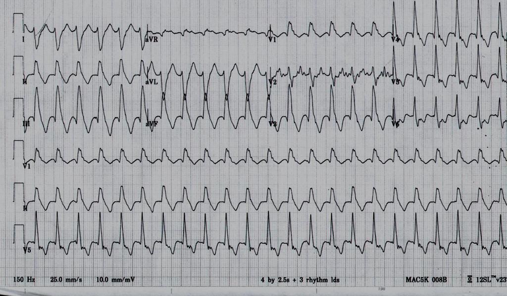 WCT Case #3 SC RBBB RAD WCT Rate 170 msec Possible P wave in lead V2