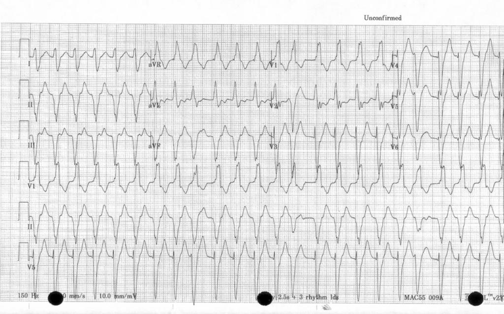 WCT Case #4 DC RBBB RAD irregular WCT Average rate 150 bpm VT suggested by AVR