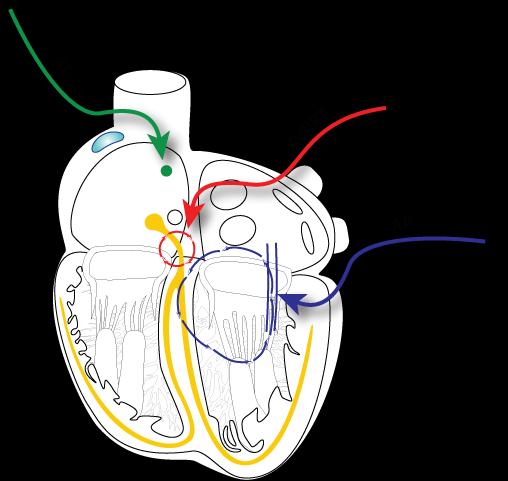 Common SVTs AT= atrial tachycardia AVNRT = AV node reentry tachycardia AP = Accessory pathway mediated tachycardia General concepts to remember: