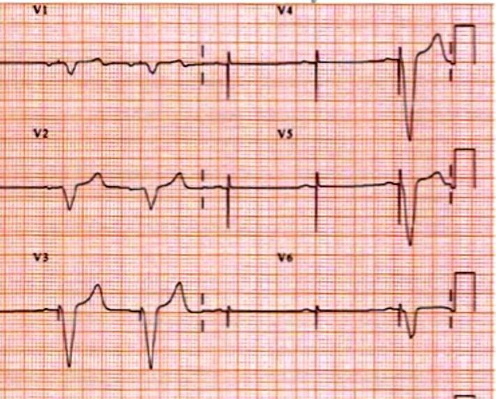 PPM Case #5 A new patient is admitted with syncope.