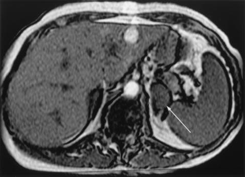 pected diagnosis of metastasis, with subsequent adrenalectomy if results of CT-guided biopsy are indeterminate [13].