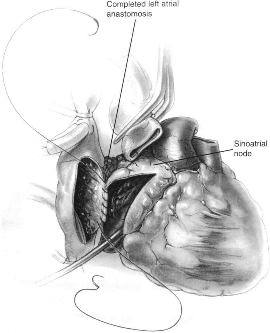 10 Right atrial anastomosis between donor and recipient is initiated next.