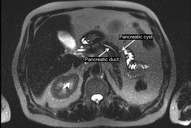 September 2010 PANCREATIC CYSTS DETECTED BY MRI 809 Table 2.