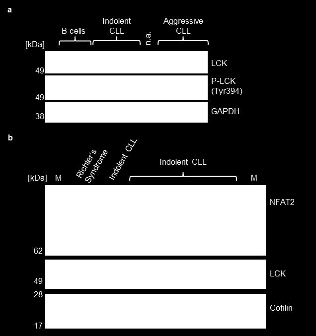 (b) Uncropped Western Blot related to Figure 7g showing NFAT2 and LCK protein expression in one patient with Richter s syndrome (n=1) and five patients