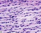 T Predominance of collagen fibers + fibroblasts rich in collagen fiber Sites: