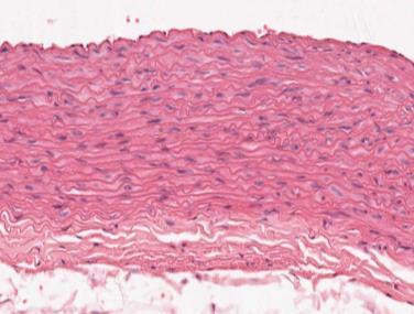 Predominance of elastic fibers (sheets or membranes) + fibroblasts rich in