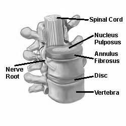 cord and causes pain in the neck, shoulders, arms and sometimes the hands. should join the vertebrae above and below to form one solid piece of bone.