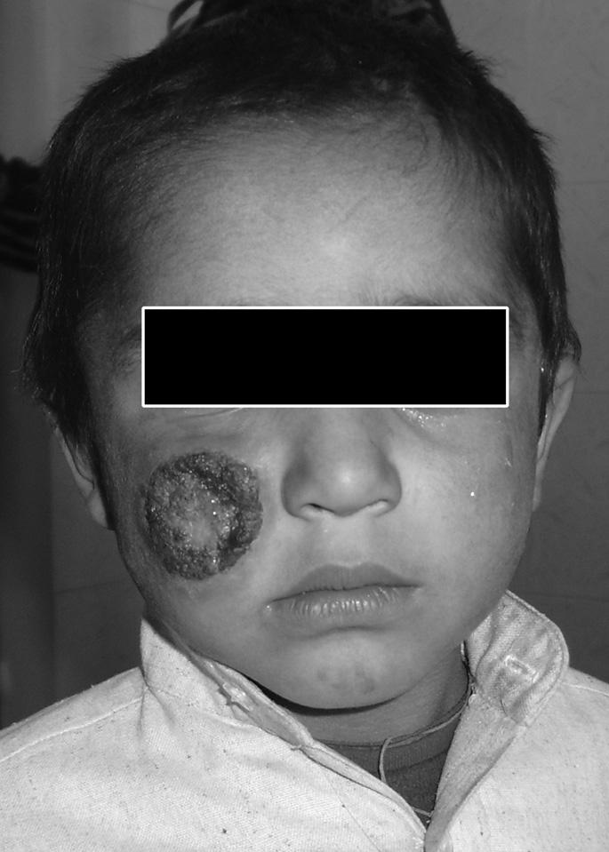 FIGURE 2. Close up picture of 5-year-old Afghan boy with a large leishmaniasis lesion on right cheek. FIGURE 1. Picture of 5-year-old Afghan boy with a large leishmaniasis lesion on right cheek.