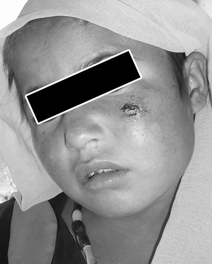 FIGURE 3. Picture of 4-year-old Afghan girl with a large leishmaniasis lesion on left cheek. FIGURE 4. Close up picture of 4-year-old Afghan girl with a large leishmaniasis lesion on left cheek.