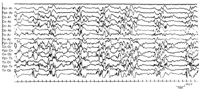 EEG demonstrates suppression-burst pattern mainly noted during sleep the burst phase is shorter