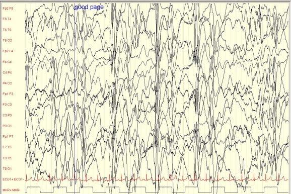 Hypsarrhythmia pattern during wakefulness Chaotic mixture of